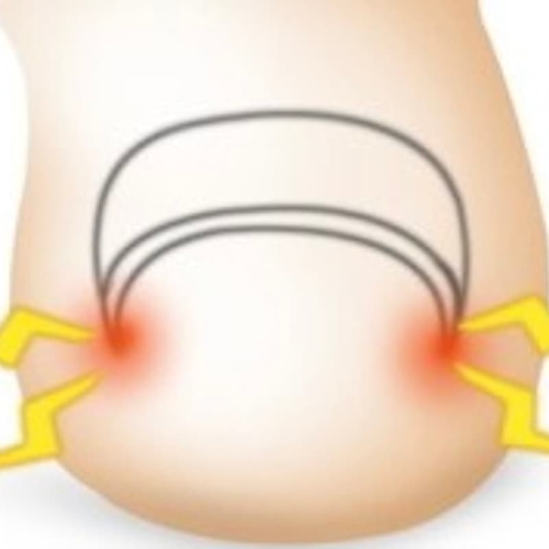 내성발톱 내성발톱/파고드는 발톱 교정