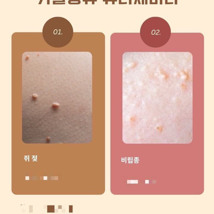 비립종,쥐젖 관리