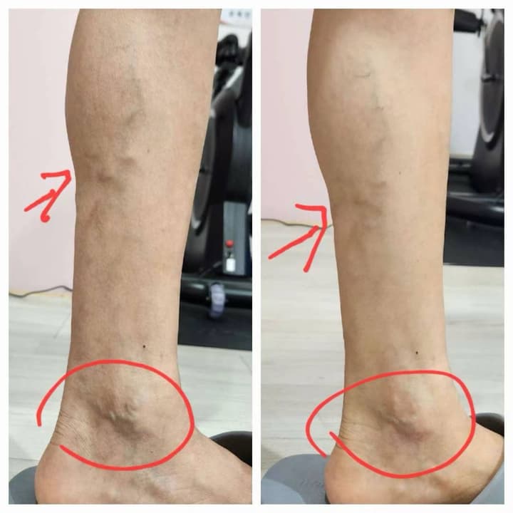 하지 정맥류