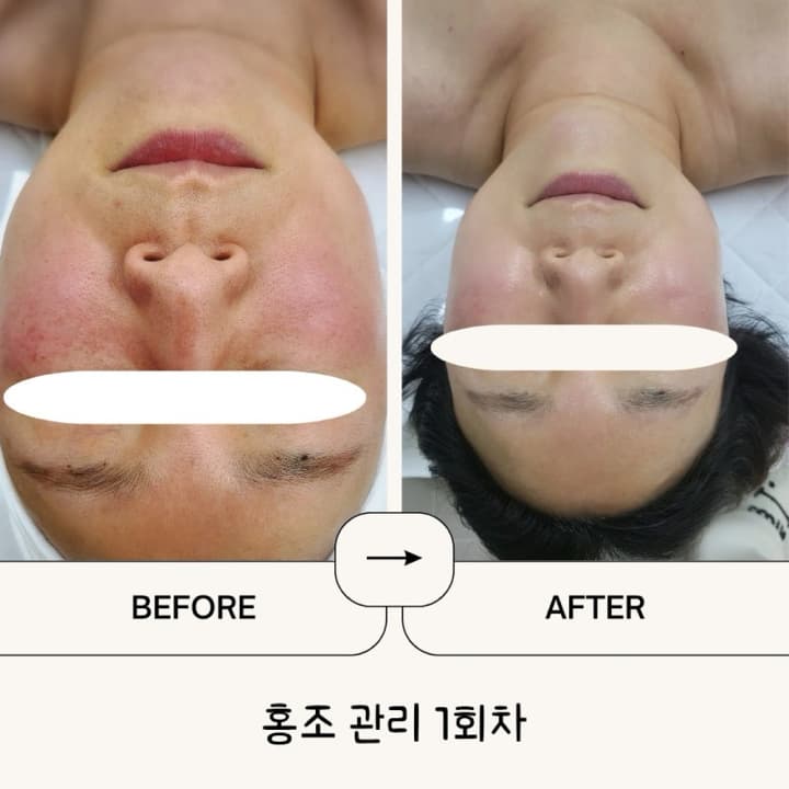 홍조 관리